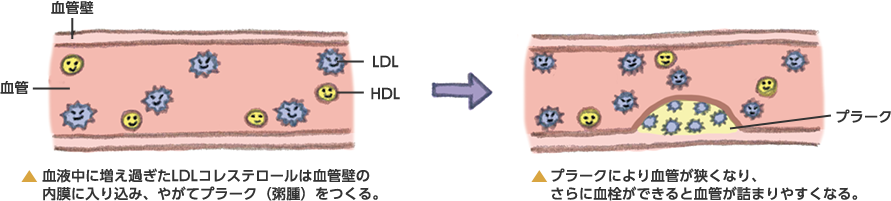 脂質異常症の説明：血液中に増え過ぎたLDLコレステロールは血管壁の内膜に入り込み、やがてプラーク（粥腫）をつくる。　動脈硬化の説明：プラークにより血管が狭くなり、さらに血栓ができると血管が詰まりやすくなる。